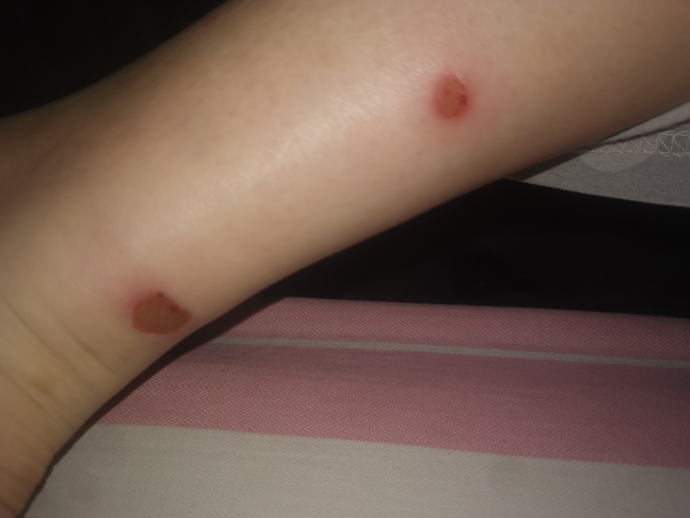 Ayak bileğim sobadan 2 yerden yandı en hızlı nasıl geçer 😥çok yanıyor?