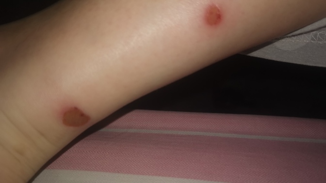 Ayak bileğim sobadan 2 yerden yandı en hızlı nasıl geçer 😥çok yanıyor?