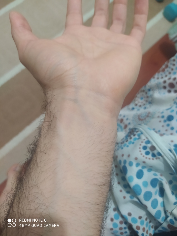 Damarlarımın bu kadar belli olması normal mi?