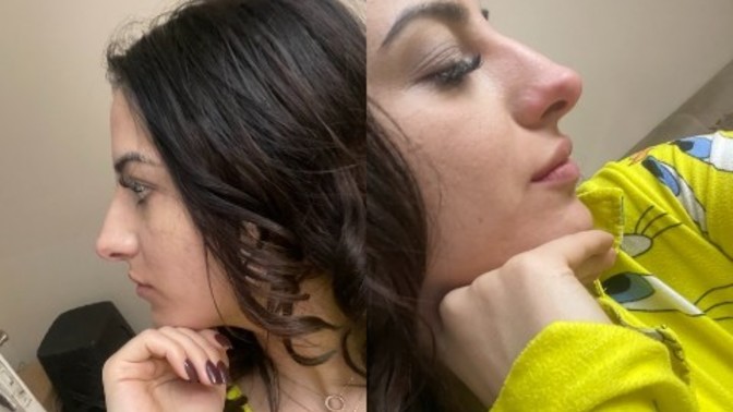 Sizce burnum ameliyat çilesi çekecek kadar büyük mü?