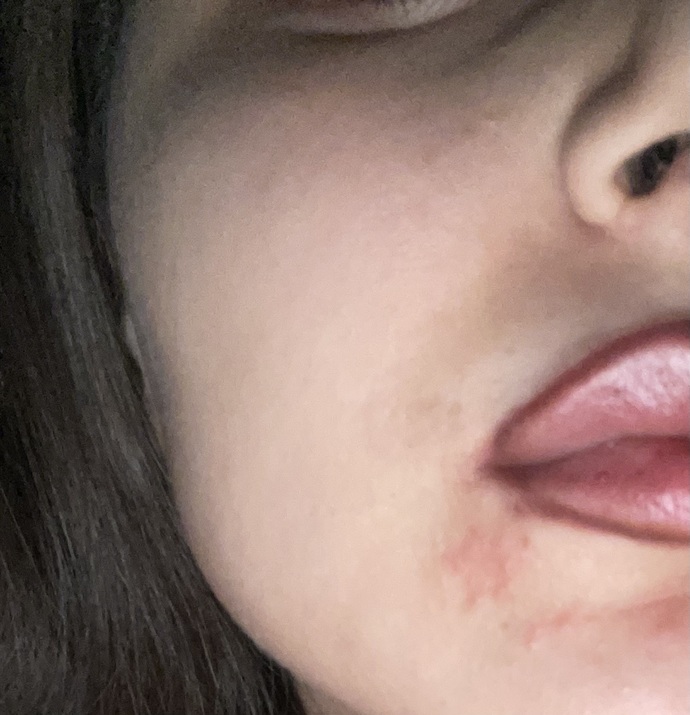 Çenemde böyle şeylet çıktı ama kaşıntı ve ağrı yok, sebebu ne ola bilir?