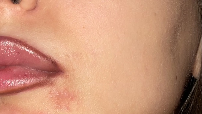Çenemde böyle şeylet çıktı ama kaşıntı ve ağrı yok, sebebu ne ola bilir?