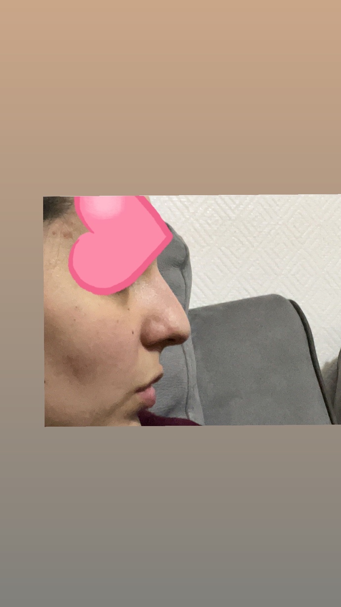 Burnum iyi mi görünüyor, yaptırmalı mıyım?