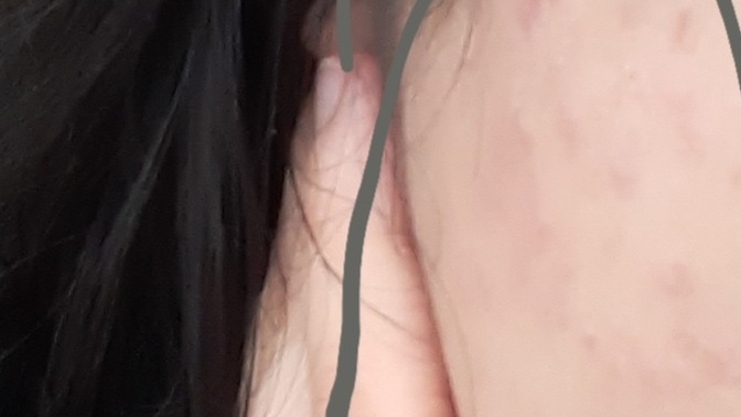 Yuzumu iple almaya başladım yuzum mahvoldu fotoda göründüğü gibi?