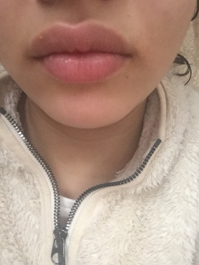 Herpes oldum, ne yapabilirim?