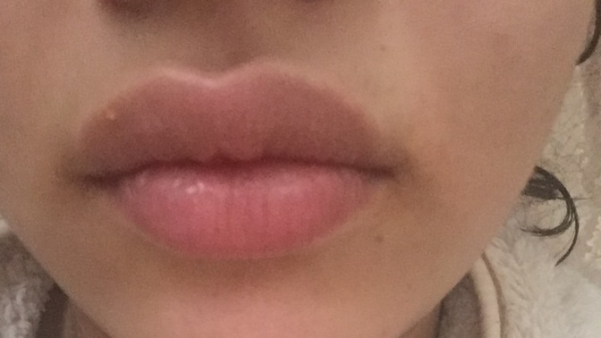 Herpes oldum, ne yapabilirim?