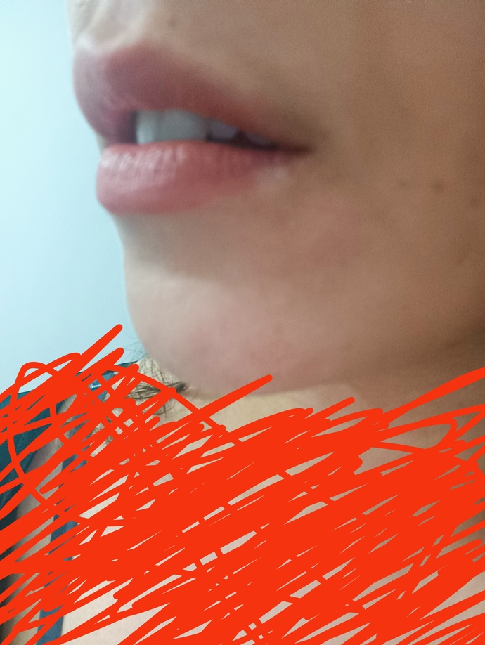 Dudaklarımın dolguya sizce ihtiyacı var mı? Çok mu ince?
