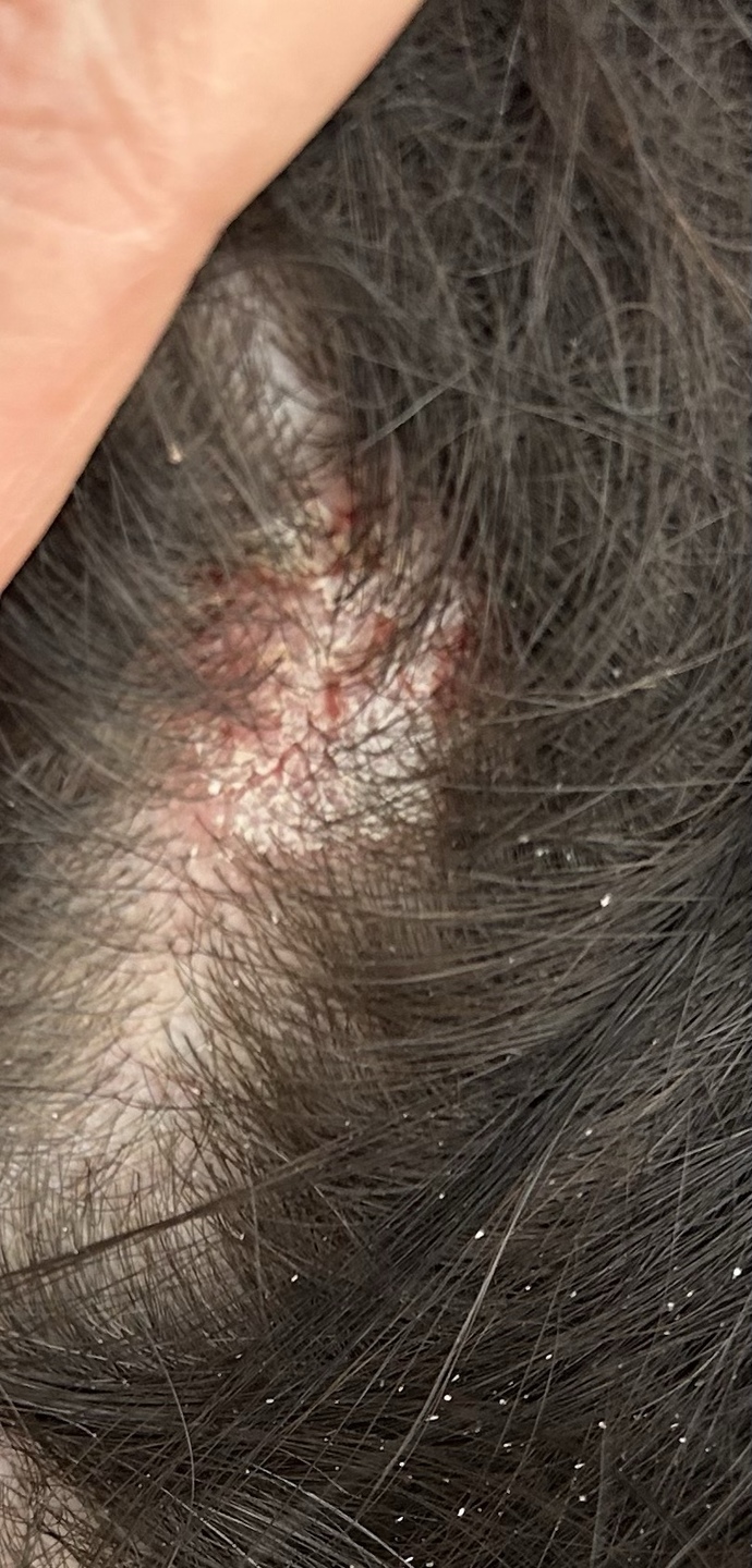 Seboreik dermatit?
