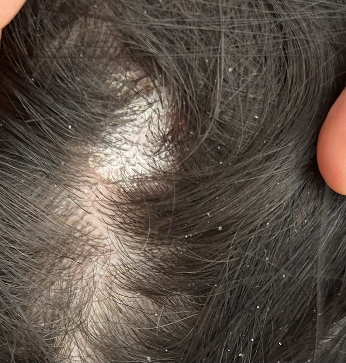 Seboreik dermatit?