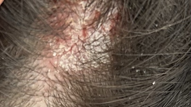 Seboreik dermatit?