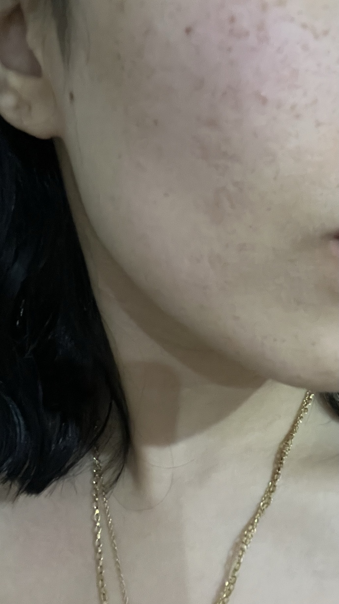 Yüzdeki çukurlar için dermapen mi yoksa plazma pen mi yapmalıyım?
