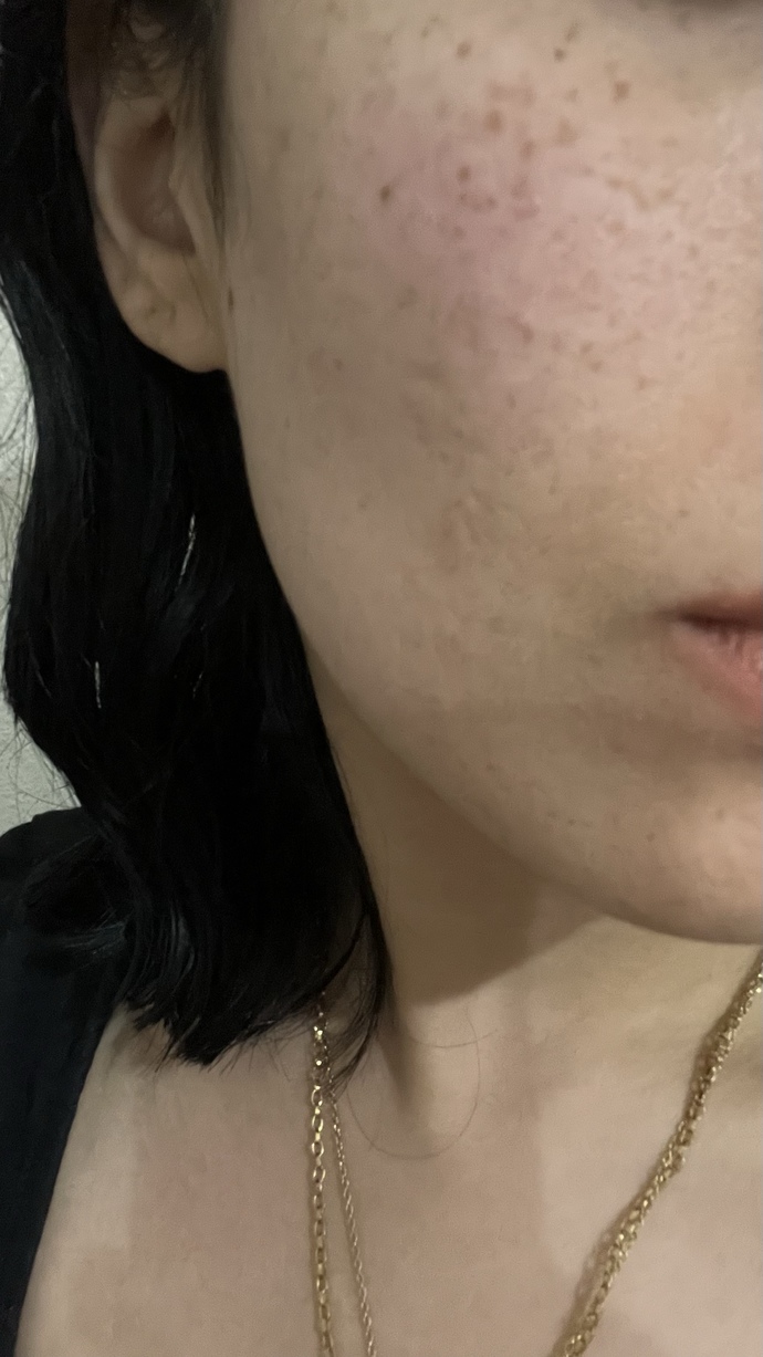 Yüzdeki çukurlar için dermapen mi yoksa plazma pen mi yapmalıyım?