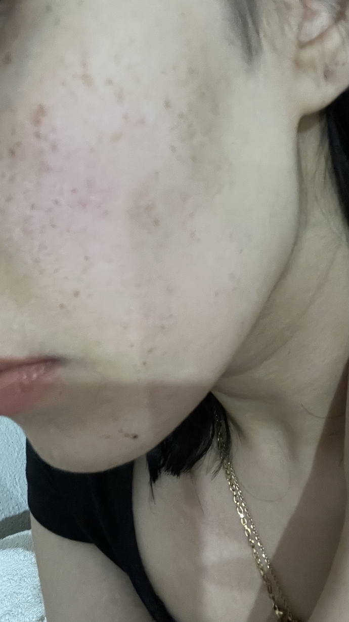 Yüzdeki çukurlar için dermapen mi yoksa plazma pen mi yapmalıyım?