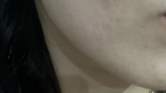 Yüzdeki çukurlar için dermapen mi yoksa plazma pen mi yapmalıyım?