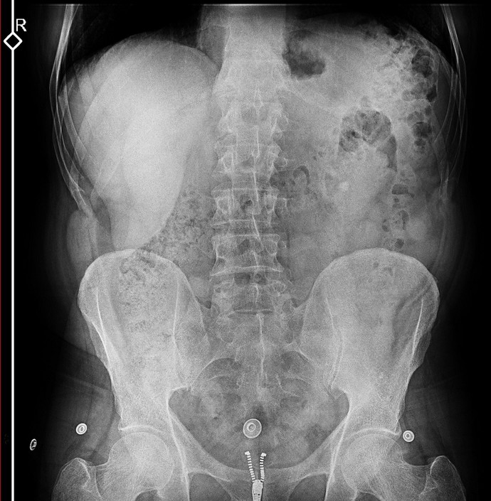 Sağlıktan anlayanlar röntgen sonucuna bakabilir mi foto bırakıyorum. Babamın sonucu öğleden sonra bakcak doktor ama dayanamadımm?