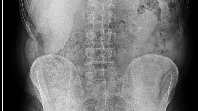 Sağlıktan anlayanlar röntgen sonucuna bakabilir mi foto bırakıyorum. Babamın sonucu öğleden sonra bakcak doktor ama dayanamadımm?