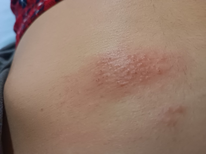 Karnımda böyle bir şey çıktı ve ne olduğunu bilmiyorum, bunu yaşamış biri var mı?