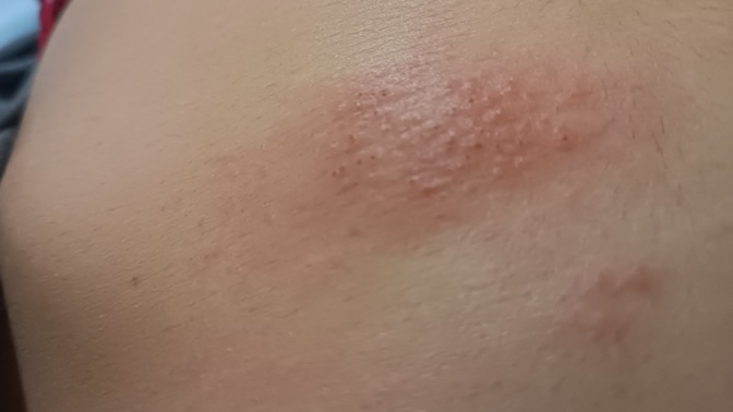Karnımda böyle bir şey çıktı ve ne olduğunu bilmiyorum, bunu yaşamış biri var mı?