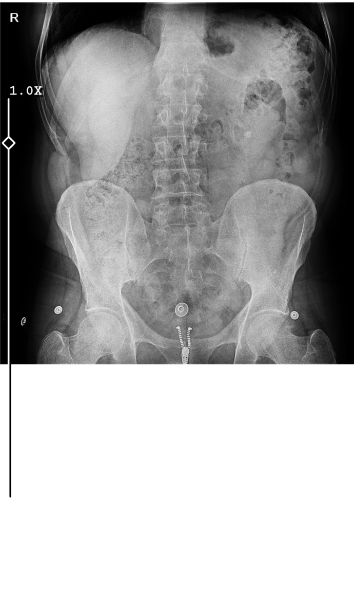 Röntgende sağ bağırsağın olduğu yerde bi şişlik var nedir o bakar misiniz foto bırakıyorum?