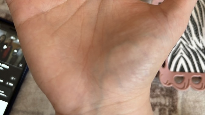 Arkadaşlar avucumdaki damar normal mi?
