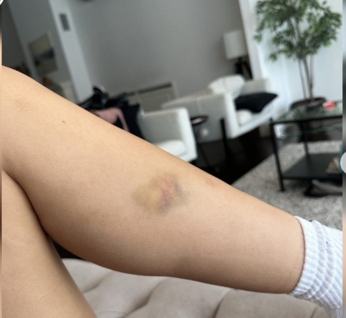 OnlyFans fenomeni Merve Taşkın, sevgilisinden şiddet gördüğünü açıkladı! Ne düşünüyorsunuz?