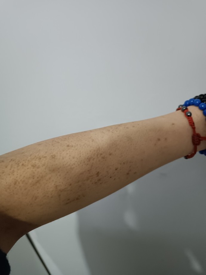 Arkadaşlar lütfen bakın kolumdaki lekeler yaralar geçer mi?