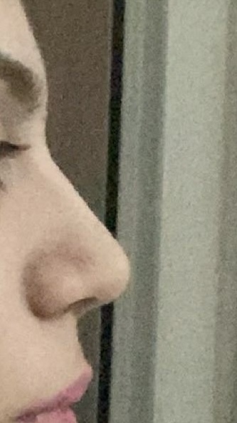 Burun estetiği olmak istiyorum sizce gerekli mi?
