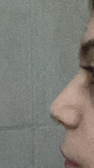 Burun estetiği olmak istiyorum sizce gerekli mi?