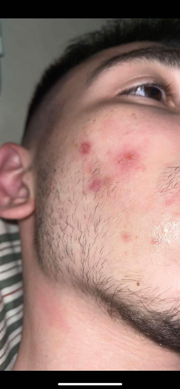 Ani sivilcelenmeler?