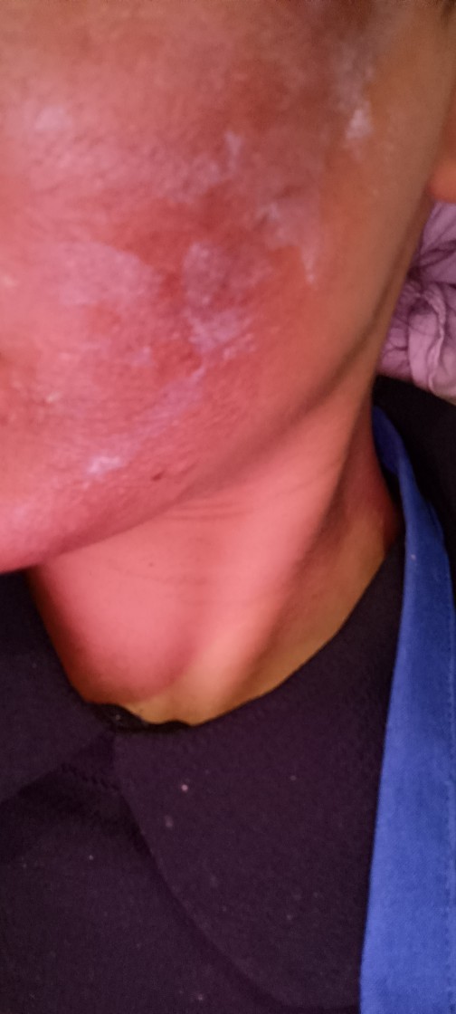 Yosun peeling yaptırdım yüzüm kötü mü duruyor?