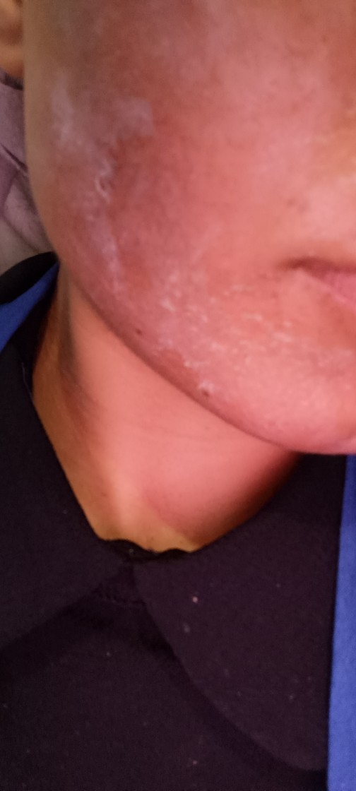 Yosun peeling yaptırdım yüzüm kötü mü duruyor?