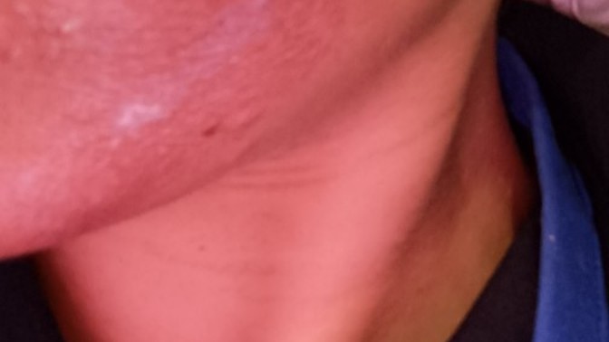 Yosun peeling yaptırdım yüzüm kötü mü duruyor?