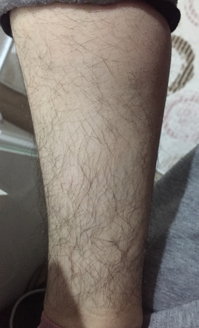 Bir kadına göre sizce çok mu kıllı hormonal bir bozukluk sorun olduğundan mıdır yoksa normal mi dalga geçmezseniz sevinirim?