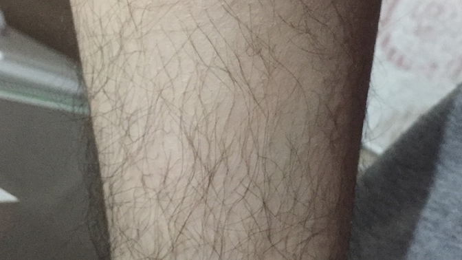 Bir kadına göre sizce çok mu kıllı hormonal bir bozukluk sorun olduğundan mıdır yoksa normal mi dalga geçmezseniz sevinirim?