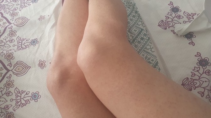 Bacaklarımda cok batık var nasil geçer?