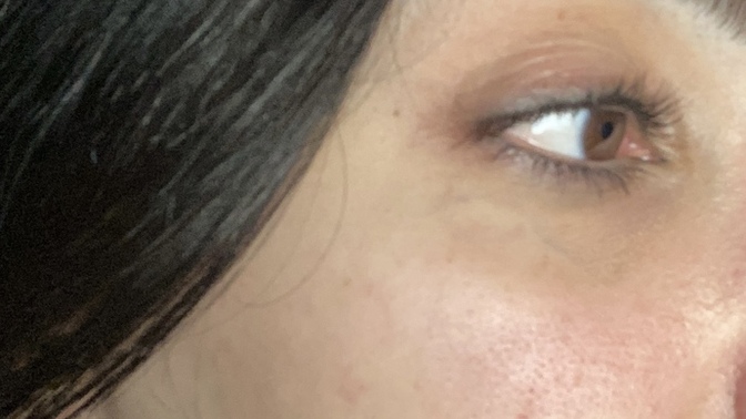 Göz çevremde mi morluk nasıl geçer ve gözenek görüntüsünü nasıl yol edebilirim :((((?