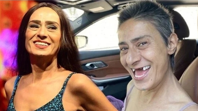 Yıldız Tilbe'nin dişsiz fotoğrafları sosyal medyada gündem oldu! Hiç implant tedavisi oldunuz mu?