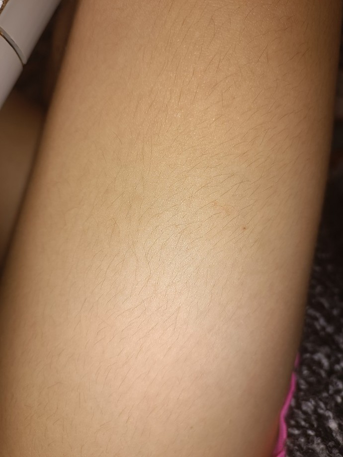 Üst Bacağımda Tüyler Var Ama Lazer Görmez Dendi ne yapsam?