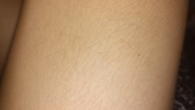 Üst Bacağımda Tüyler Var Ama Lazer Görmez Dendi ne yapsam?