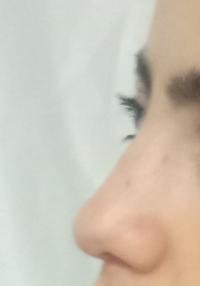 Sizce benim burnumun estetiğe ihtiyacı var mı?