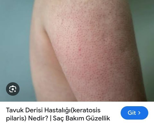 Aranızda tavuk derisi olan var mı?