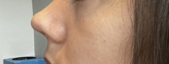 Burnum çok kalkık oldu iner mi sizce?