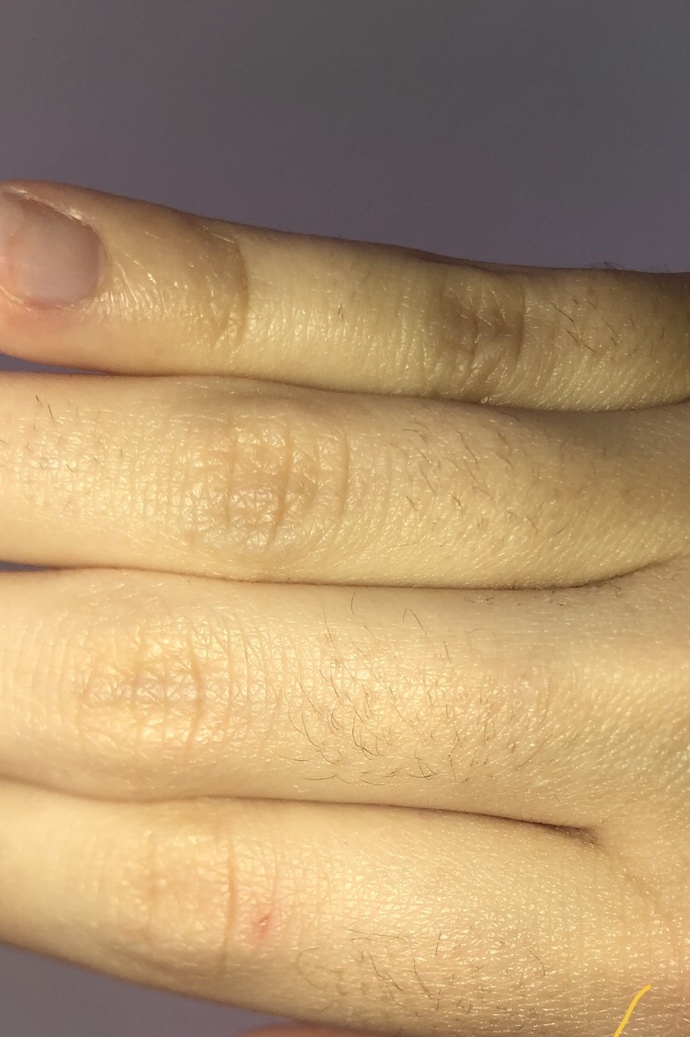 Kızlarda parmak üstünde böyle tüyler olması normal mi ağdayla alıyordm ama çıkıyor sürekli artık bazen cımbızla çekiyorum az olunc?