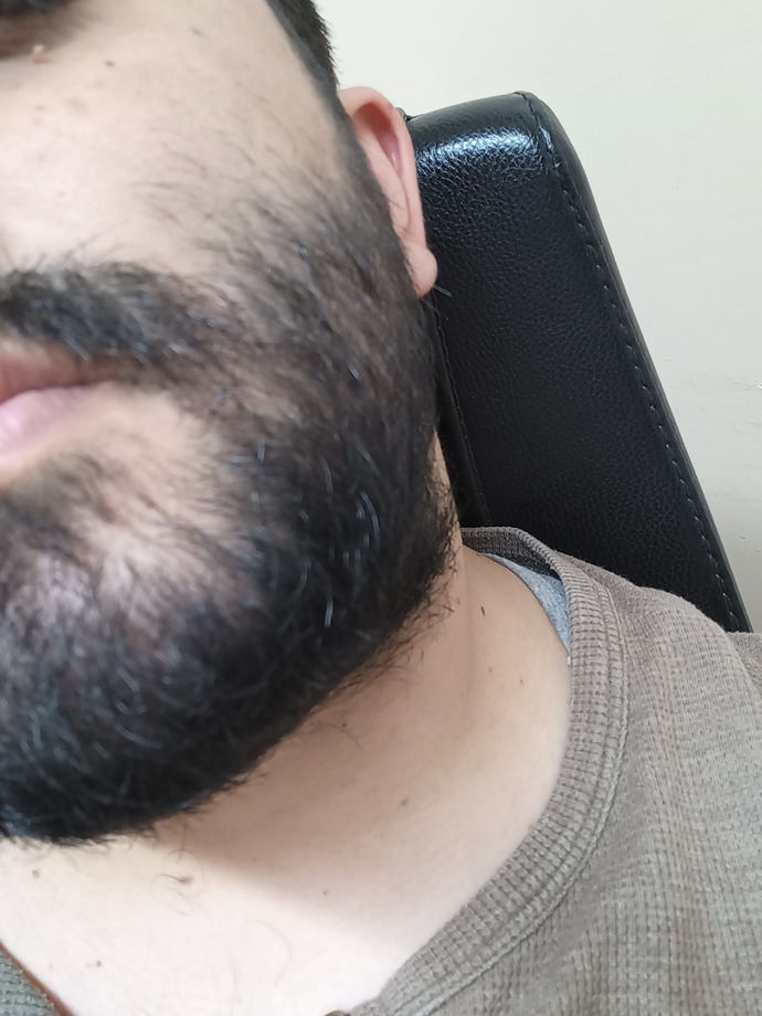 Yüzümdeki bu şeyler nasıl geçer?