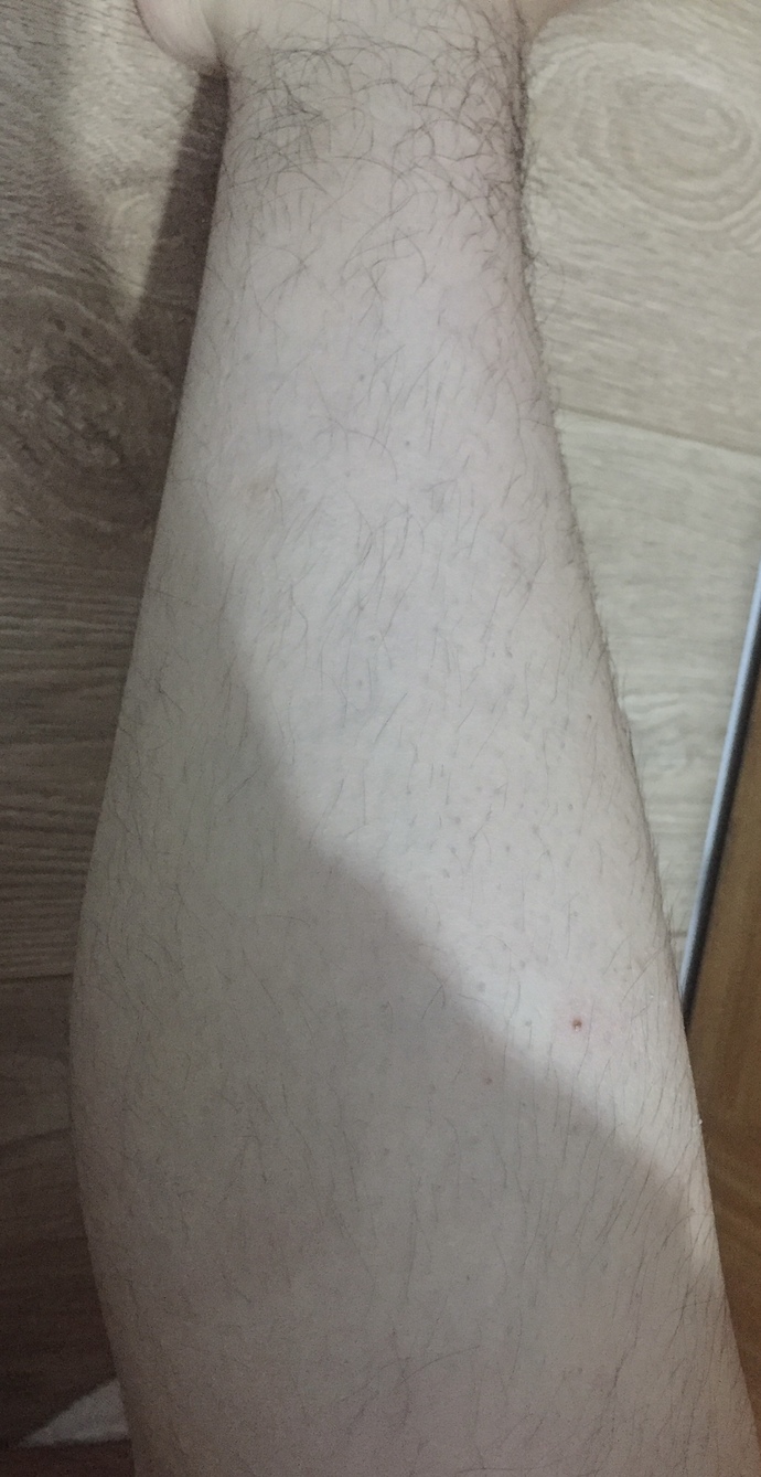 Yargılamazsınız umarım ama ben beyaz tenliyim ve vücudumda üst bacakta pek tüy olmamasına rağmen ayak bileklerim alt bacağım neden?