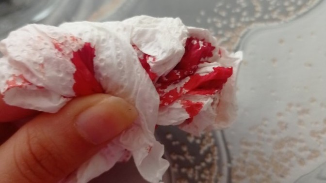 Parmağımı kestim kan durmuyor?