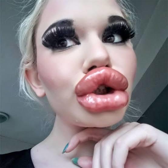 Kadınlar neden dudaklarına Botox yaptırır?