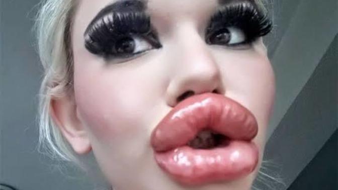 Kadınlar neden dudaklarına Botox yaptırır?