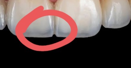 Dişlerim çürüdü sandim şeffaflaşmıs napcam?