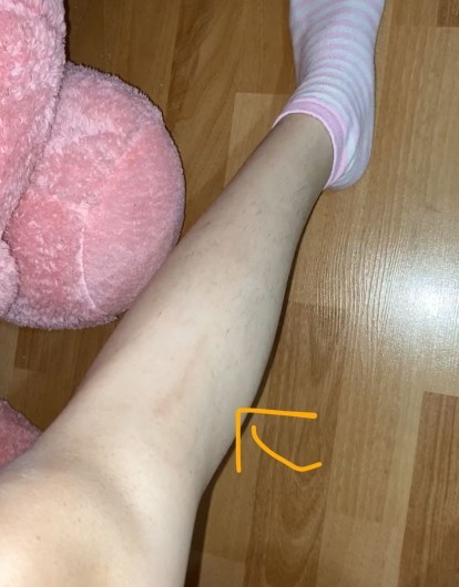Duş alirken jiletle bacagimi kestim boyle iz kaldi sizce gecer mi iz kalirmi cok agladim cok belli oluyor sizce belli mi?